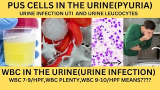 PUS CELLS IN THE URINEPYURIAWBC IN THE URINEURINE LEUCOCYTES CAUSES SYMPTOMS AND TREATMENT [upl. by Anaiq]