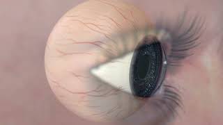 Animation Diabetic Retinopathy [upl. by Kirstin]