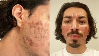 CO2 Laser Treatment for Acne Scars [upl. by Leticia]