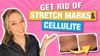 How to Get Rid of Stretch Marks amp Cellulite from a Dermatologist  Dr Shereene Idriss [upl. by Elok]