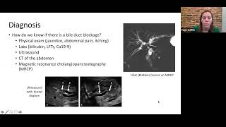 Webinar Biliary stent and drain management for patients with cholangiocarcinoma [upl. by Octavla876]