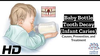 Baby Bottle Blues The Silent Threat of Tooth Decay in Infants Unveiled [upl. by Yann]