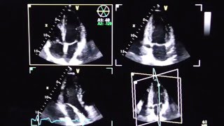 Triplane Echokardiographie triplane echocardiography [upl. by Nire]