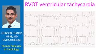 RVOT ventricular tachycardia [upl. by Pasquale]