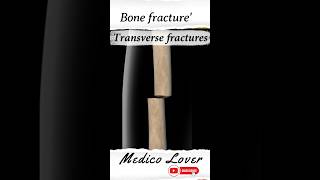 Different types of Bone fracture [upl. by Martyn]