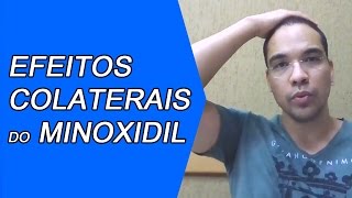 Previnase Contra os Efeitos Colaterais do Minoxidil 5 [upl. by Introk183]