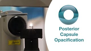 Yag Laser Capsulotomy for Posterior Capsule Opacification [upl. by Jordanna859]