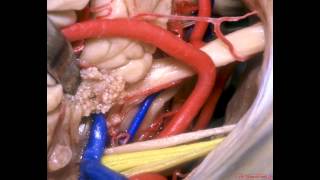 Approaches to the Brainstem [upl. by Odawa710]