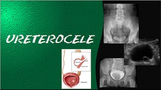 Videoaula e dicas em RADIOLOGIA  ultrassonografia urografia excretora e cistografia  Ureterocele [upl. by Sidnac]