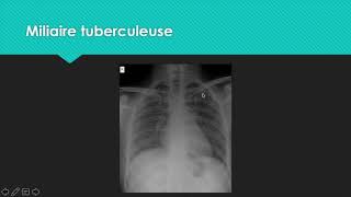 M2 Analyse de la radiographie thoracique parenchyme [upl. by Rehpoitsirhc]