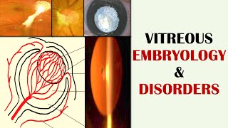 Development of Eye Primary Secondary and Tertiary Vitreous and its Disorders [upl. by Aztilem]