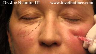 5 minute cheeks by Dr Joe Niamtu III [upl. by Euqinaj]