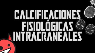 Calcificaciones fisiológicas intracraneales [upl. by Mirth]