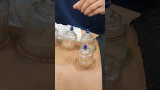 Cupping therapy for back pain bestphysiotherapy physioterapy cuppingtherapy [upl. by Ansley]