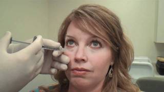 Juvéderm™ Tear Trough Treatment Huntsville Alabama  Dr David L Durst [upl. by Natassia]