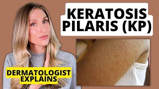 Dermatologist Explains Keratosis Pilaris KP Affordable Drugstore Treatments to Try [upl. by Odetta297]