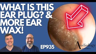 THATS NOT AN EARWAX PLUG amp MORE EAR WAX REMOVALS  EP935 [upl. by Nelia]