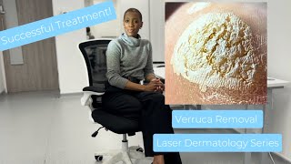 Verruca Wart Removal Laser Treatment [upl. by Anialem]