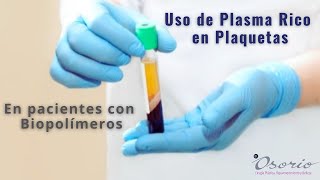 Plasma Rico en Plaquetas en pacientes con biopolímeros [upl. by Quillon981]