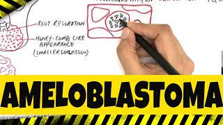 Ameloblastoma  Origination Clinical Radiographic amp Histopathologic features [upl. by Johan634]