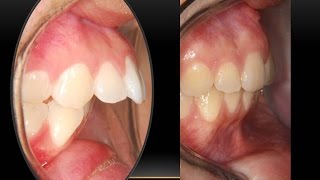 Amazing Over jet Correction with miniscrews Orthodontist [upl. by Lundgren]