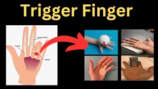 A Complete Guide to Trigger Finger [upl. by Frannie]