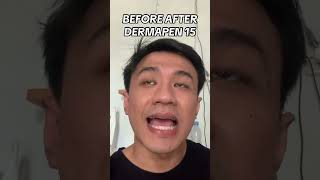 Before after demapen 15 dermapen dermapenmicroneedling bopeng [upl. by Yesnik991]