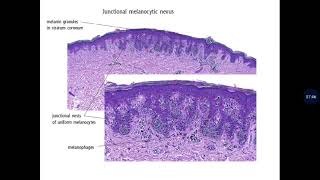 Basic Dermatopathology 18 Melanocytic tumors [upl. by Sephira123]