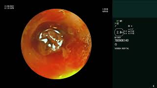 Pulmonary Mucormycosis  Massive hemoptysis  Bronchoscopy [upl. by Aimerej]