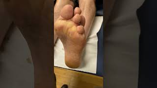 Say goodbye to painful corns Watch our expert podiatrist in action PainFreeFeet CornRemoval [upl. by Punke886]