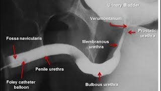 Retrograde Urethrogram  Ascending urethrography [upl. by Ase906]