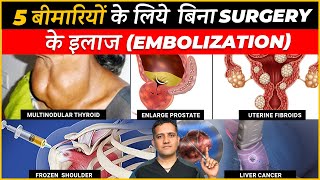 Treatment of 5 Conditions with Angiography Based Technique Embolisation  Dr Gaurav Gangwani IR [upl. by West359]