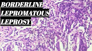 Borderline Lepromatous Leprosy Histopathology [upl. by Hedve104]