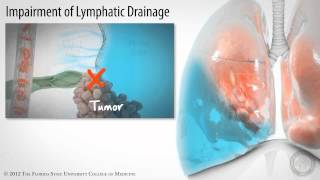 Pleural Space Part 3 of 3 Pleural Effusions HD [upl. by Ahcarb773]