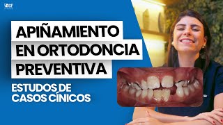 CASOS CLÍNICOS DE APIÑAMIENTO EN ORTODONCIA PREVENTIVA [upl. by Jammin224]