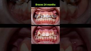 Braces correct all cases of crooked teeth braces orthodontist bracket [upl. by Amarillis]