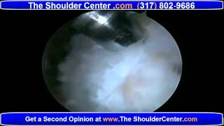 Rotator Cuff ReTears  How to Repair 2nd Rotator Cuff Surgery [upl. by Willtrude]