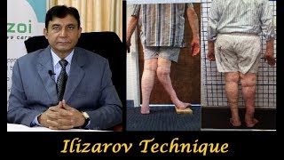 Ilizarov Technique Explained by Dr Subhash Shalya Orthopedic Surgeon in Delhi [upl. by Ahsima]