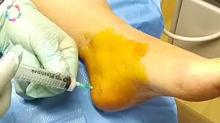 Painfree steroid injection by Podiatrist in UK for plantarfasciitis  heel pain [upl. by Ronald]