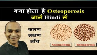 Osteoporosis kyu hota hai Osteoporosis ka ilaz kya hai All about Osteoporosis [upl. by Pinckney]