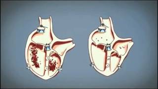 Arresto Cardiaco e Defibrillatore [upl. by Macrae]