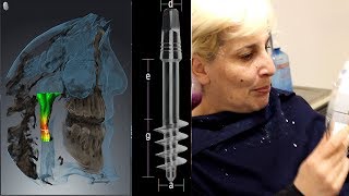 Implant dentaire basal 2  Témoignage douleurs opération avis [upl. by Kassi375]