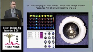 Brain Toxicity From Cobalt in Artificial Hip Implants As Seen on PET Scan [upl. by Deloris125]