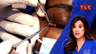 Tackling the Toughest Surgery Yet  Dr Pimple Popper TLC [upl. by Un]