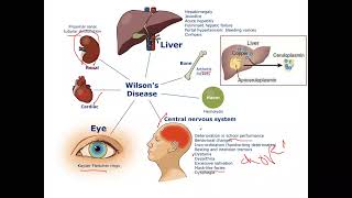 pediatric Hepatology Wilsons Disease [upl. by Mialliw]