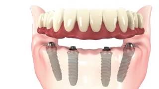 Allon4 Dental Implants Simple Procedure Animation [upl. by Acino]