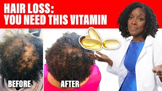 Hair Loss This Vitamin Can Save Your Hair [upl. by Halden]