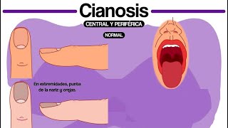 🔴 CIANOSIS CENTRAL VS PERIFERICA [upl. by Eile]