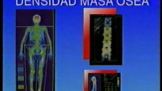 OSTEOPOROSIS Y ALIMENTACIÓN [upl. by Schaffel967]