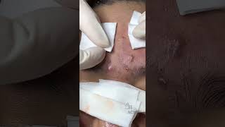 Inflamed Acne and Blackhead Removal CloseUp [upl. by Irtimd]